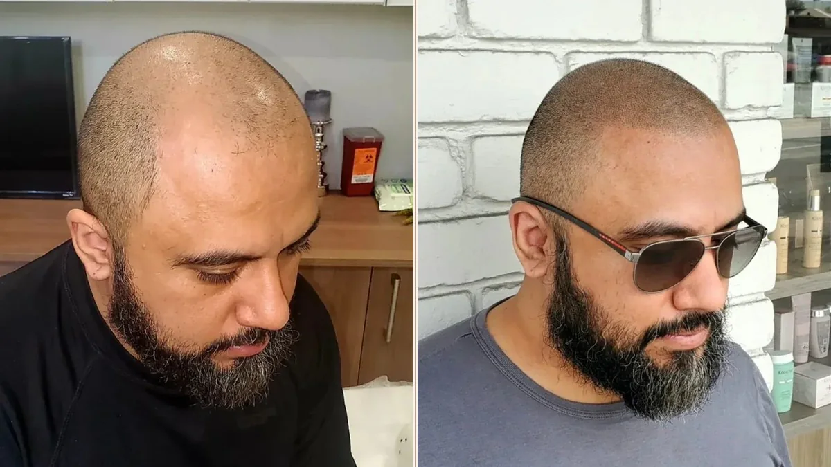 Side-by-side hairline photographs from the HairDot.Ink before-and-after gallery