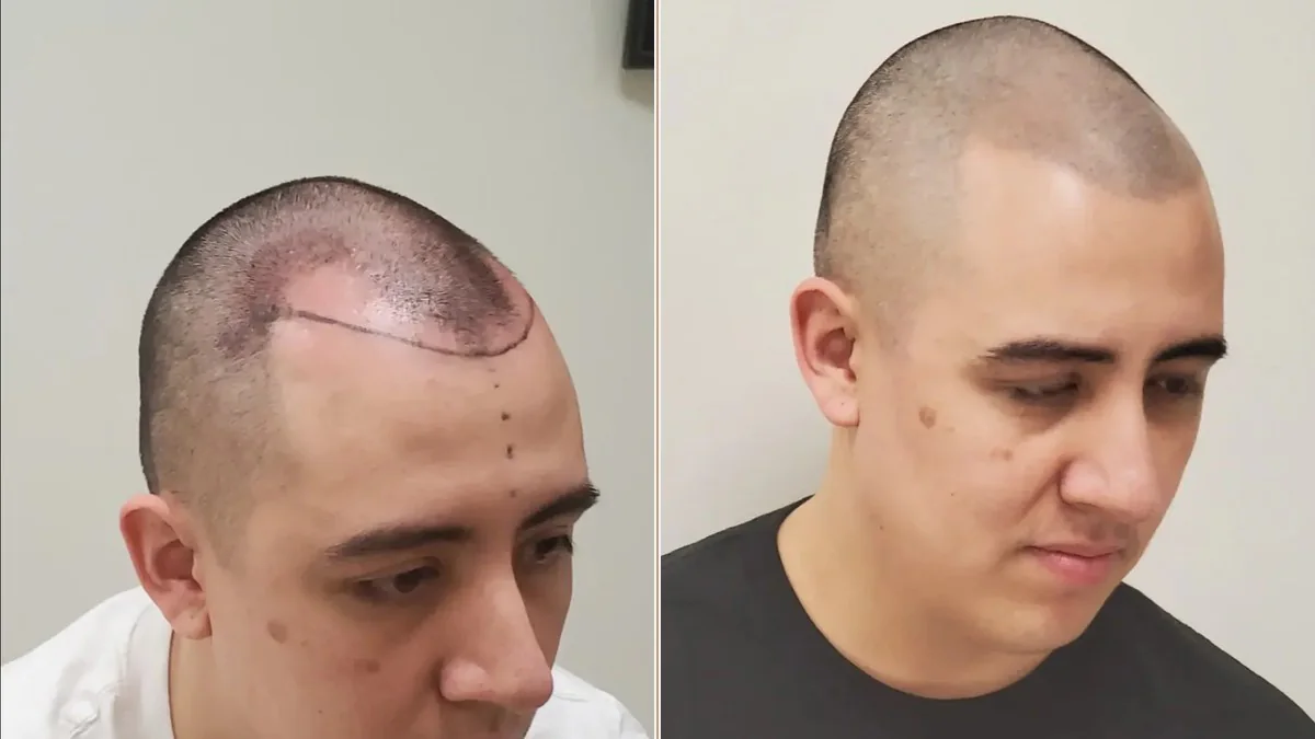 Side-by-side hairline and temple photographs from the HairDot.Ink before-and-after gallery