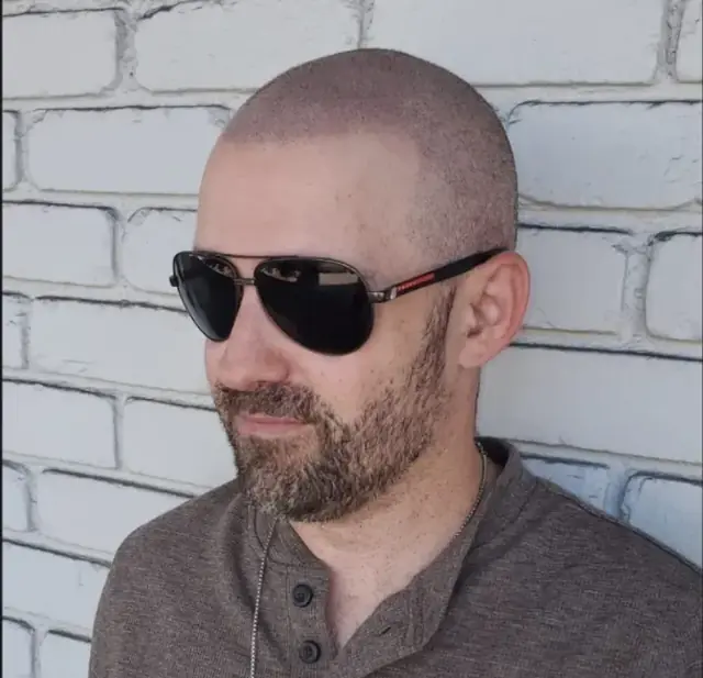 HairDot scalp micropigmentation work, shared with permission