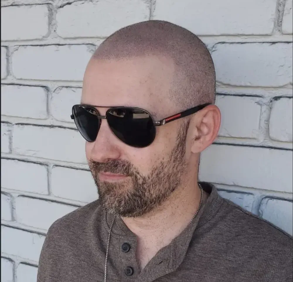 An existing scalp micropigmentation result from the HairDot.Ink gallery
