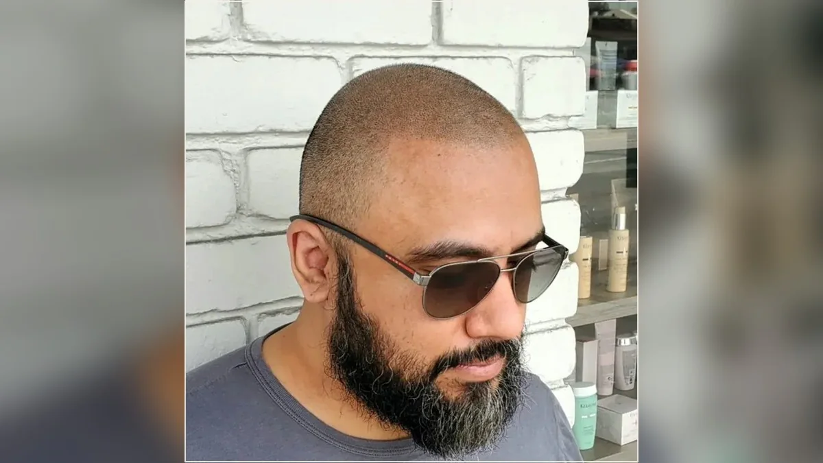 Scalp micropigmentation result showing the hairline and scalp from the HairDot.Ink gallery