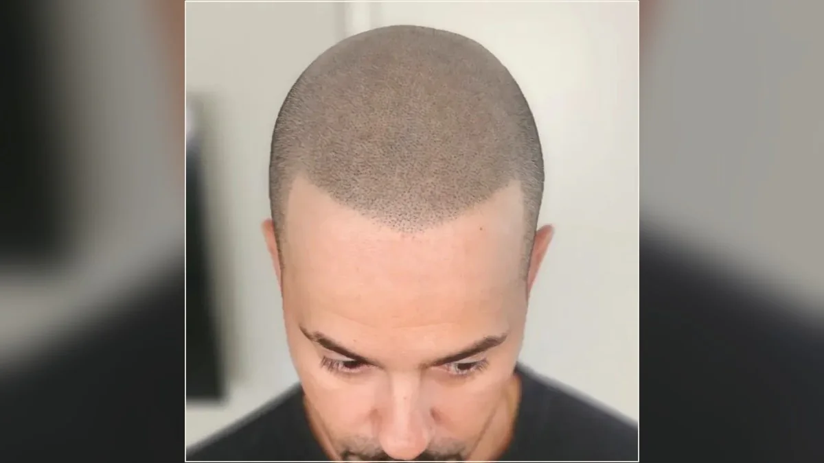 Scalp micropigmentation result showing the hairline and scalp from the HairDot.Ink gallery