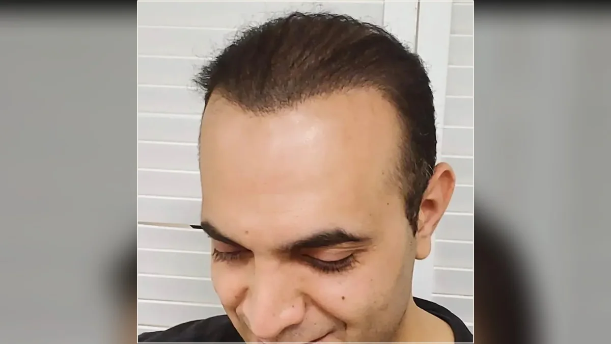 Scalp micropigmentation result showing the hairline and scalp from the HairDot.Ink gallery