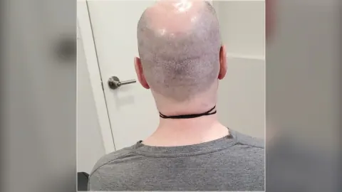 Back-of-scalp photograph showing SMP coverage from the HairDot.Ink gallery