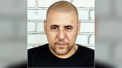 Scalp micropigmentation result showing the hairline and scalp from the HairDot.Ink gallery