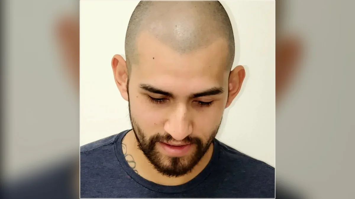 Scalp micropigmentation result showing the hairline and scalp from the HairDot.Ink gallery