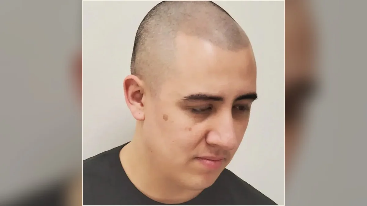 Scalp micropigmentation result showing the hairline and scalp from the HairDot.Ink gallery