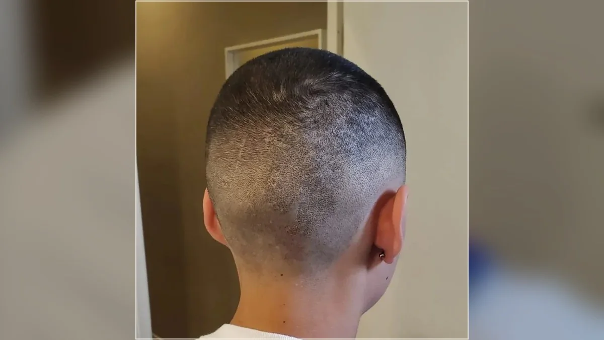 Back-of-scalp photograph showing SMP coverage from the HairDot.Ink gallery