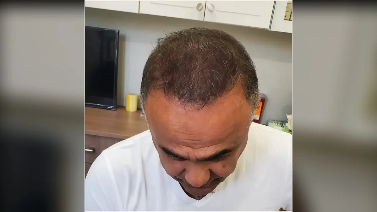 Scalp micropigmentation result showing the hairline and scalp from the HairDot.Ink gallery