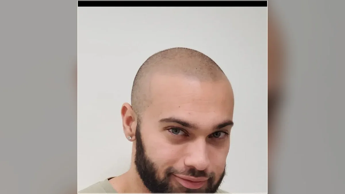 Scalp micropigmentation result showing the hairline and scalp from the HairDot.Ink gallery