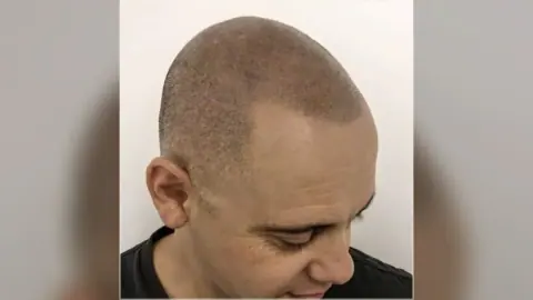 Scalp micropigmentation result showing the hairline and scalp from the HairDot.Ink gallery