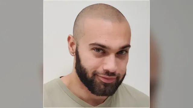 HairDot scalp micropigmentation work, shared with permission