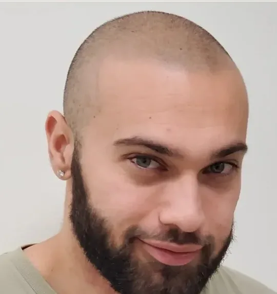 HairDot scalp micropigmentation work, shared with permission