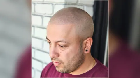 Side view of a scalp micropigmentation result from the HairDot.Ink website