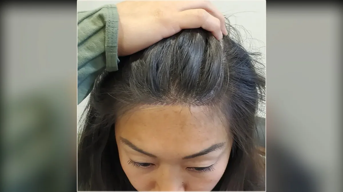 Existing hair and scalp visible near the front hairline in a HairDot.Ink gallery photograph