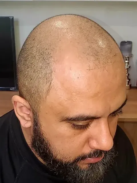 HairDot SMP comparison 1, before