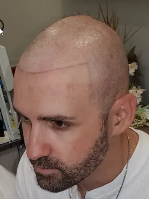 HairDot SMP comparison 2, before