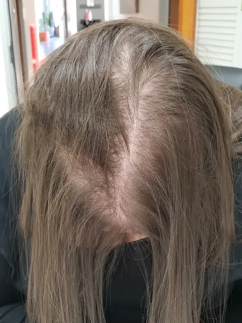 HairDot SMP comparison 3, before