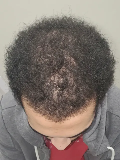 HairDot SMP comparison 4, before