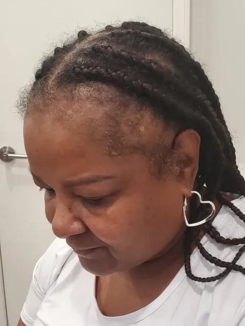 HairDot SMP comparison 6, before
