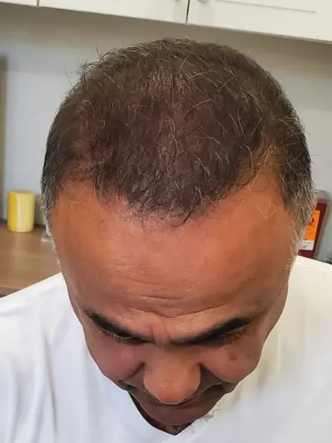 HairDot SMP comparison 7, after