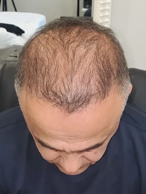 HairDot SMP comparison 7, before