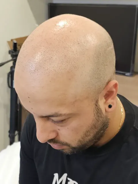 HairDot SMP comparison 8, before