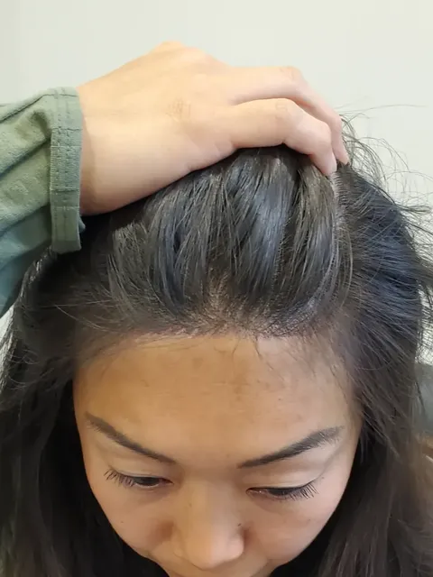 HairDot SMP comparison 9, after