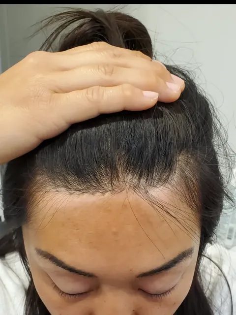 HairDot SMP comparison 9, before