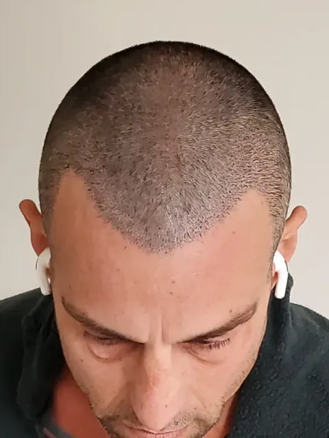 HairDot SMP comparison 10, after