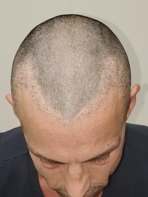 HairDot SMP comparison 10, before