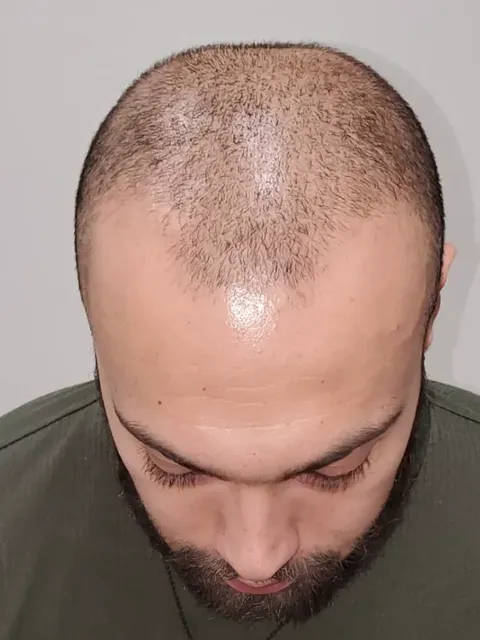 HairDot SMP comparison 11, before