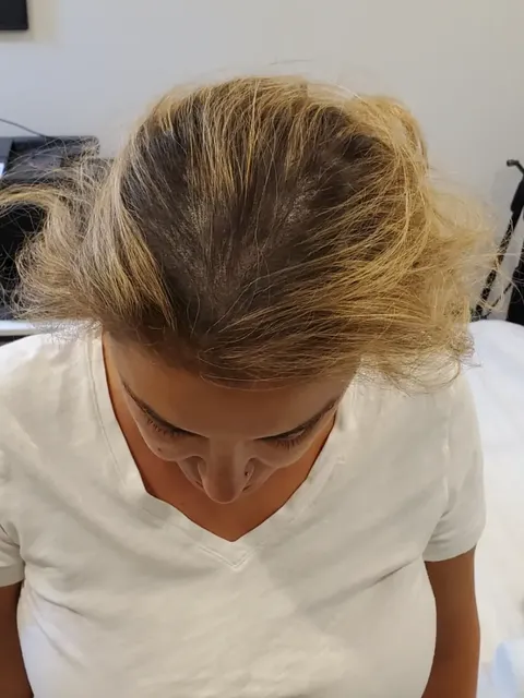 HairDot SMP comparison 12, after