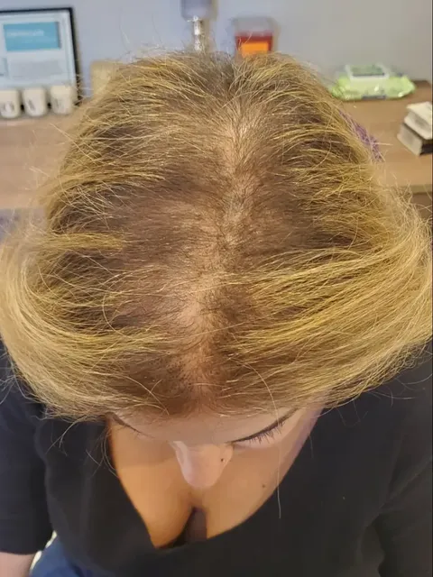 HairDot SMP comparison 12, before