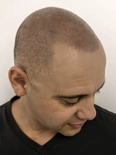 HairDot SMP comparison 13, after