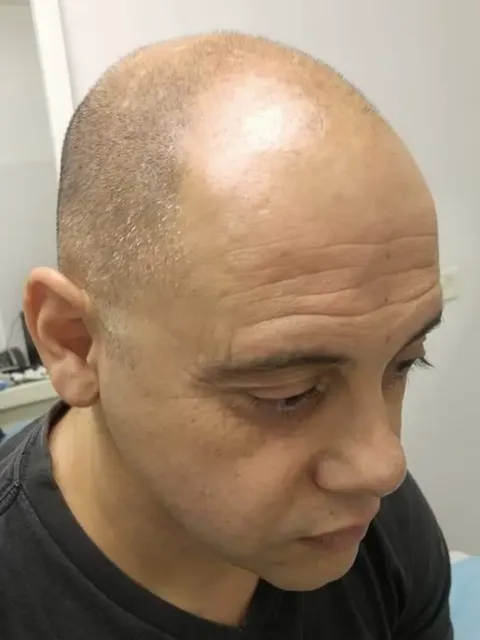 HairDot SMP comparison 13, before