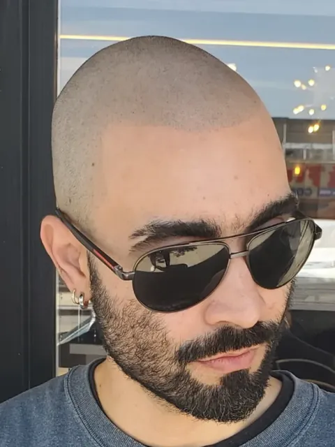 HairDot SMP comparison 14, after