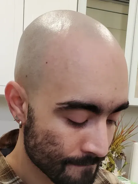 HairDot SMP comparison 14, before