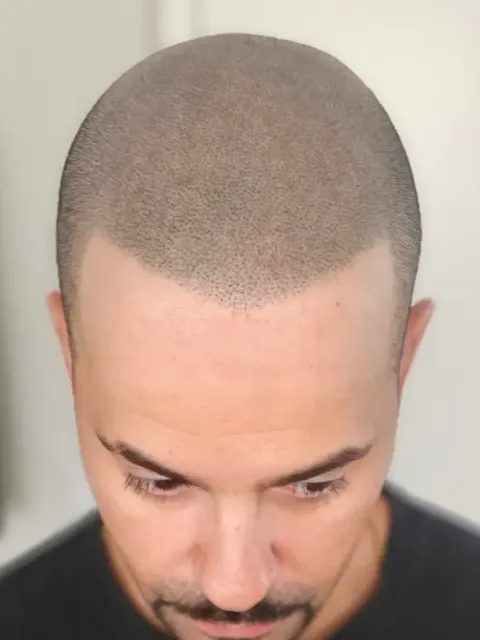 HairDot SMP comparison 16, after