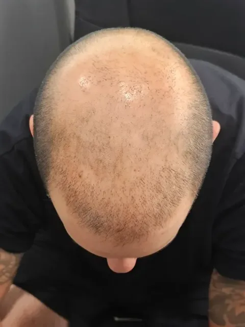 HairDot SMP comparison 16, before