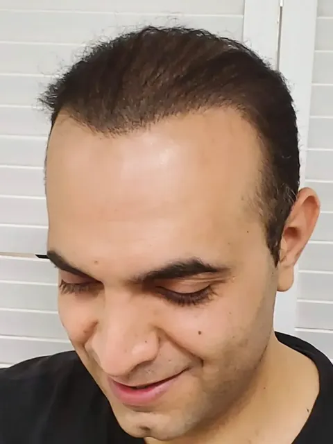 HairDot SMP comparison 17, after