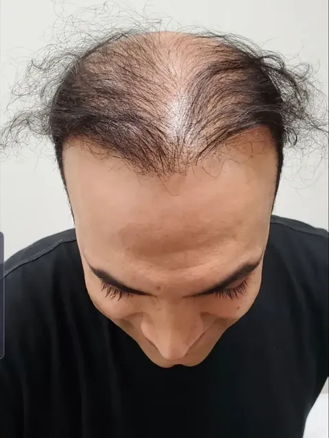 HairDot SMP comparison 17, before