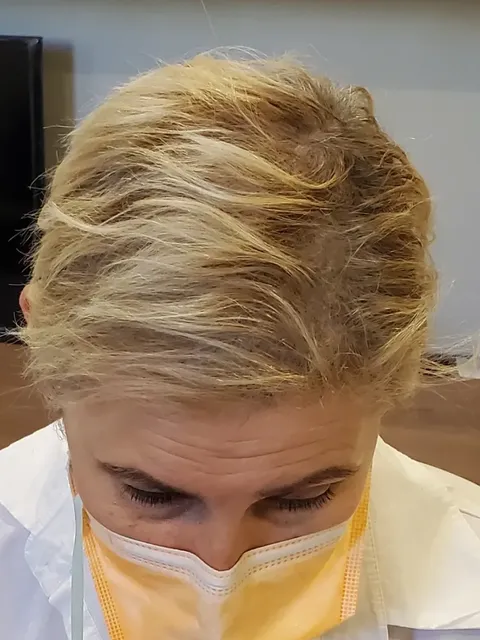 HairDot SMP comparison 18, after