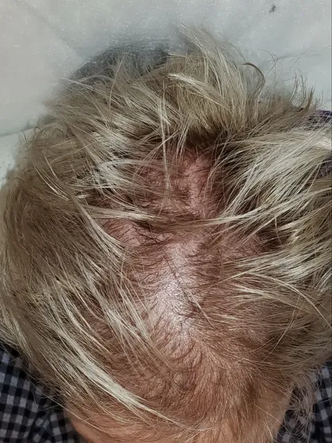 HairDot SMP comparison 18, before