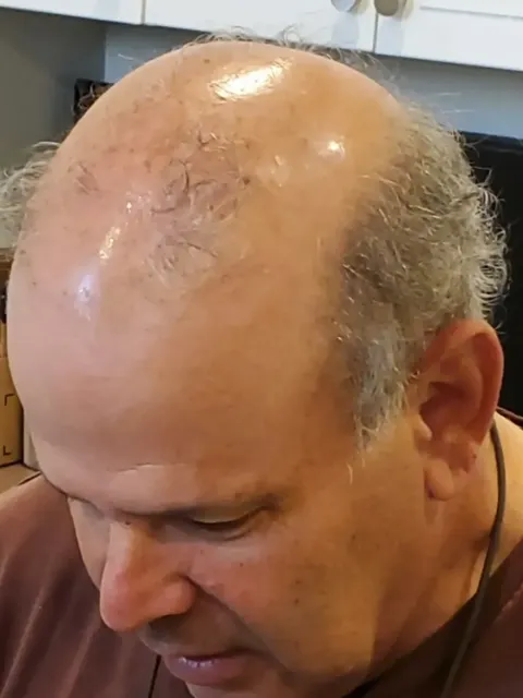 HairDot SMP comparison 19, before