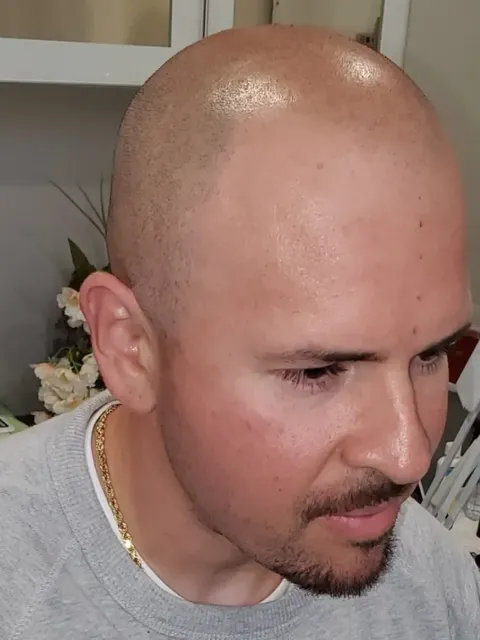 HairDot SMP comparison 20, before