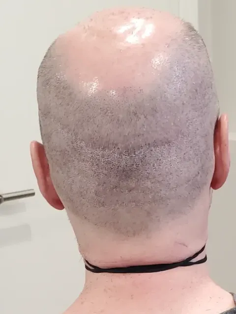 HairDot SMP comparison 21, after