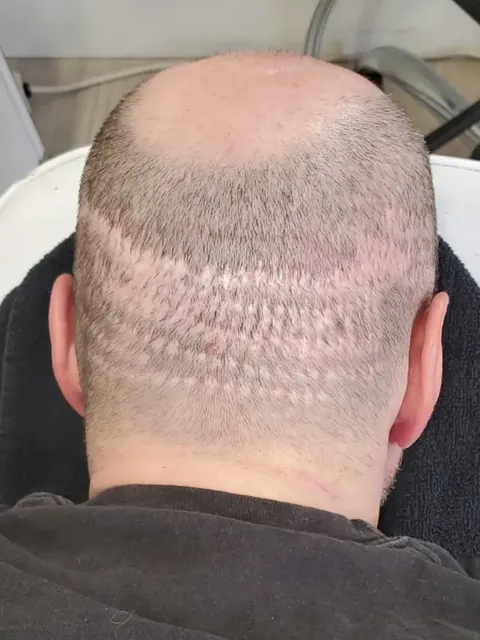 HairDot SMP comparison 21, before