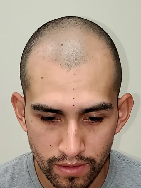 HairDot SMP comparison 23, before