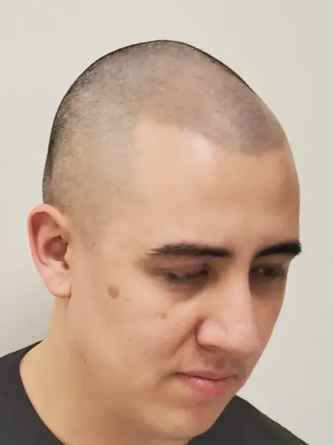 HairDot SMP comparison 24, after
